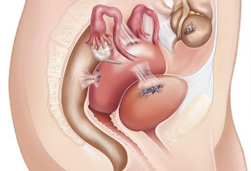 indre endometriose av livmoren